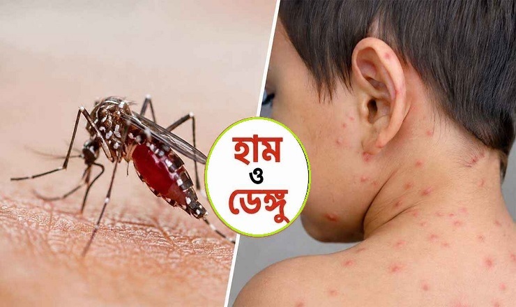 হামের উপসর্গে ৭ জনের মৃত্যু, ডেঙ্গুতে আরও ৬